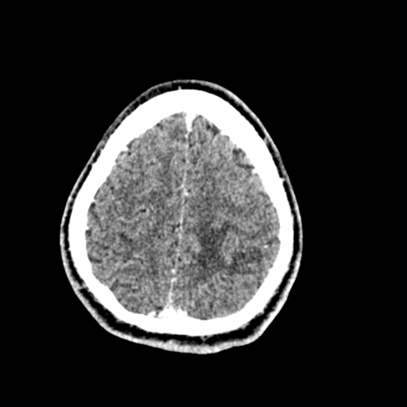 Cerebral toxoplasmosis (Radiopaedia 53993-60131 Axial C+ delayed 61).jpg