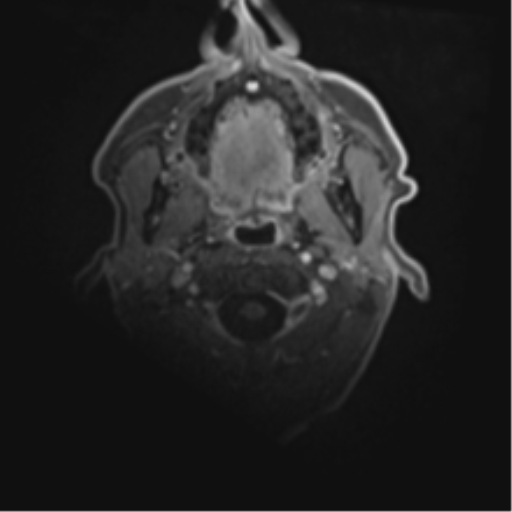 Cerebral toxoplasmosis (Radiopaedia 54575-60804 Axial T1 C+ 2).png