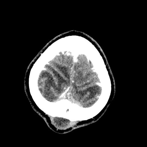 File:Cerebral tuberculosis with dural sinus invasion (Radiopaedia 60353-68019 Axial C+ delayed 61).jpg