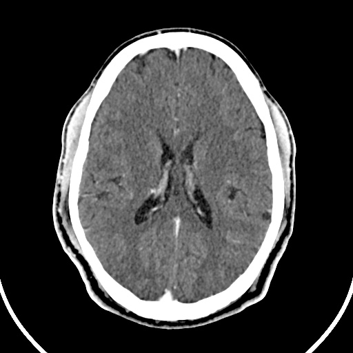 File:Cerebral venous angioma (Radiopaedia 69959-79977 B 58).jpg