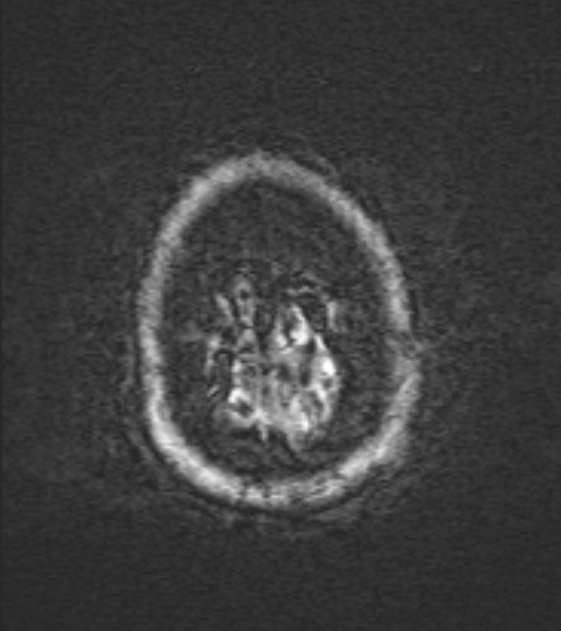 Cerebral venous infarct (Radiopaedia 53627-59685 Axial SWI 55).jpg