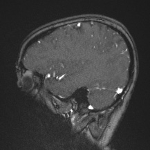 Cerebral venous infarction - hemorrhagic (Radiopaedia 81625-95505 Sagittal MRV 58).jpg