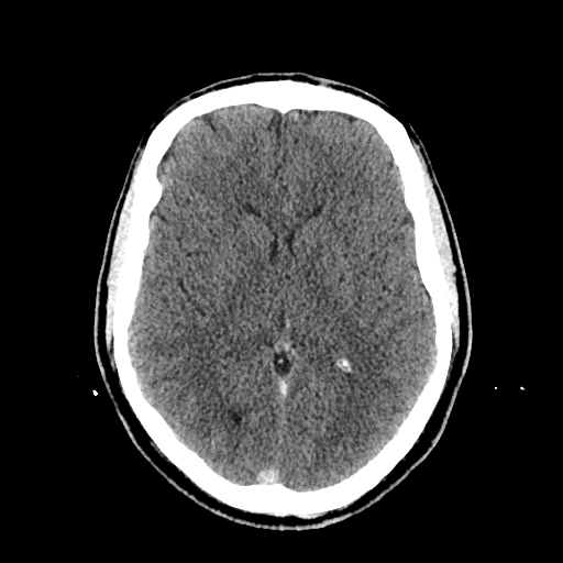 File:Cerebral venous thrombosis (CVT) (Radiopaedia 77524-89685 Axial non-contrast 25).jpg