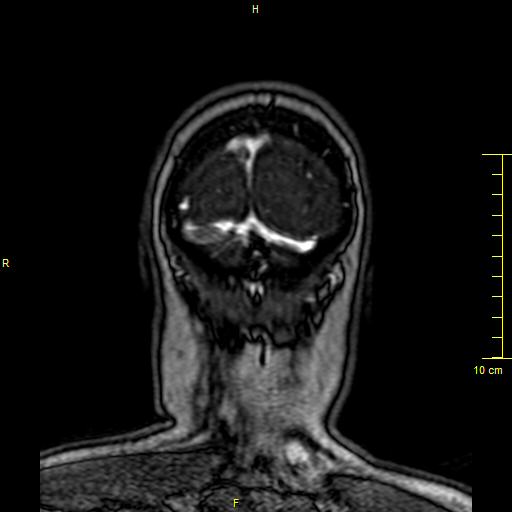 Cerebral venous thrombosis (Radiopaedia 23288-23351 MRV 167).JPG