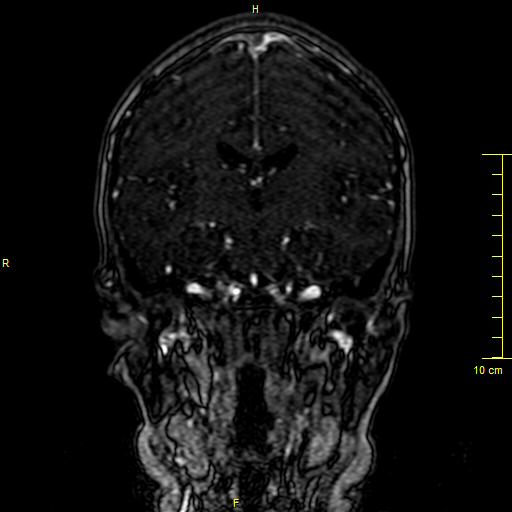 Cerebral venous thrombosis (Radiopaedia 23288-23351 MRV 78).JPG