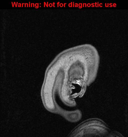 Cerebral venous thrombosis (Radiopaedia 37224-39208 Sagittal T1 C+ 3).jpg