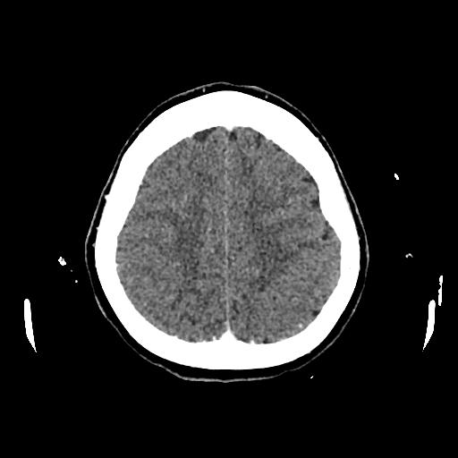 File:Cerebral venous thrombosis with venous hemorrhagic infarct (Radiopaedia 90354-107660 Axial with contrast 128).jpg
