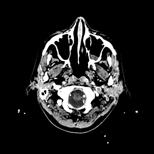 Cerebral venous thrombosis with venous hemorrhagic infarct (Radiopaedia 90354-107660 Axial with contrast 13).jpg