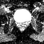 File:Cervical adenocarcinoma (Radiopaedia 65011-73985 Axial ADC 11).jpg