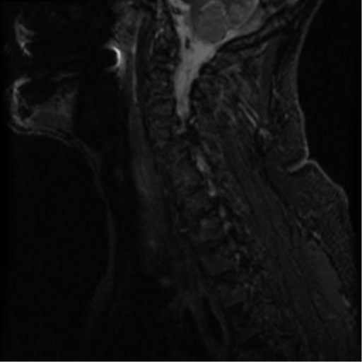File:Cervical canal stenosis with cord compression (Radiopaedia 34114-35374 Sagittal STIR 10).png