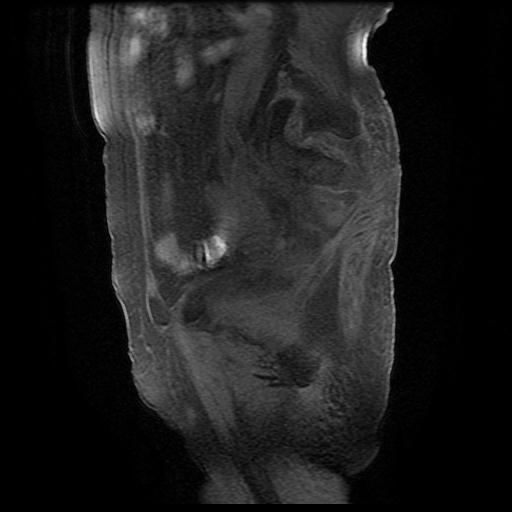 File:Cervical carcinoma (Radiopaedia 78847-91705 Sagittal T1 fat sat 4).jpg