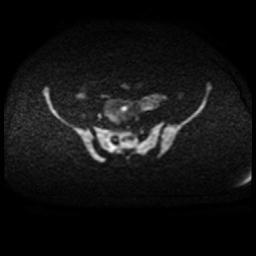 Cervical carcinoma (Radiopaedia 88010-104555 Axial DWI 78).jpg