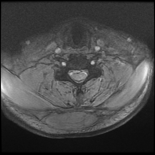 Cervical disc extrusion (Radiopaedia 59074-66364 F 37).jpg