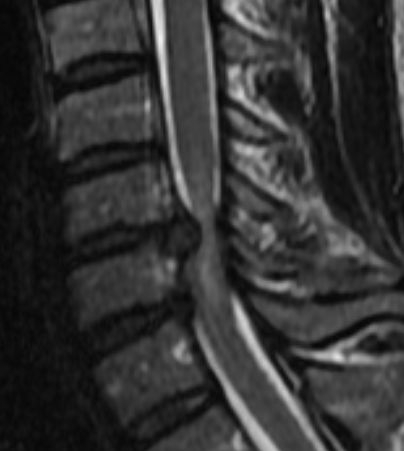 File:Cervical disc herniation with spinal cord compression (Radiopaedia 14353-14266 T2 1).jpg