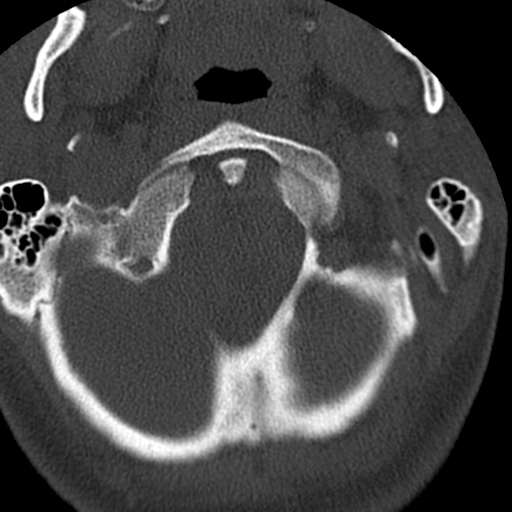 Cervical schwannoma (Radiopaedia 57979-64974 Axial bone window 9).png