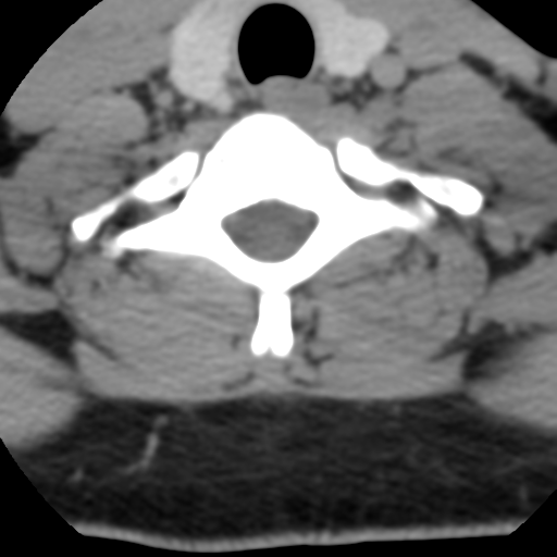 Cervical schwannoma (Radiopaedia 57979-64974 Axial non-contrast 53).png