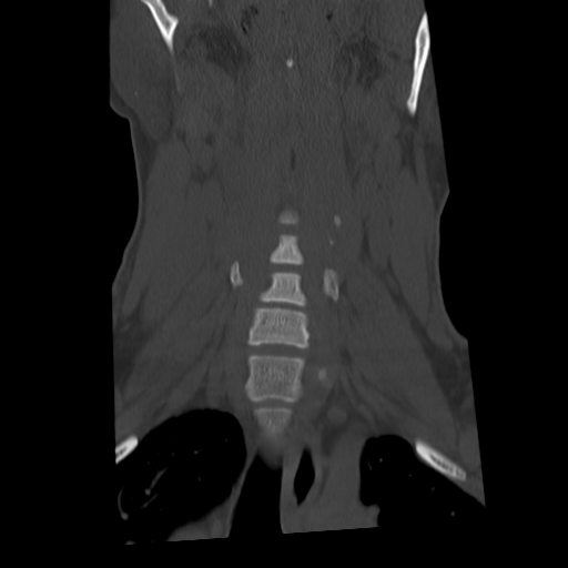 Cervical schwannoma (Radiopaedia 57979-64974 Coronal bone window 22).png