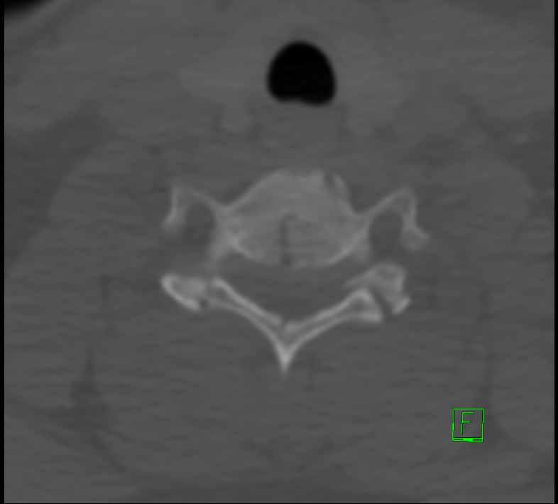 Cervical spine fracture - hyperflexion injury (Radiopaedia 66184-75364 Axial bone window 40).jpg
