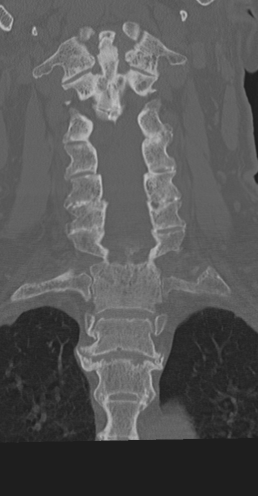 Cervical spine fracture in the setting of ankylosis (Radiopaedia 37038-38715 Coronal bone window 35).png