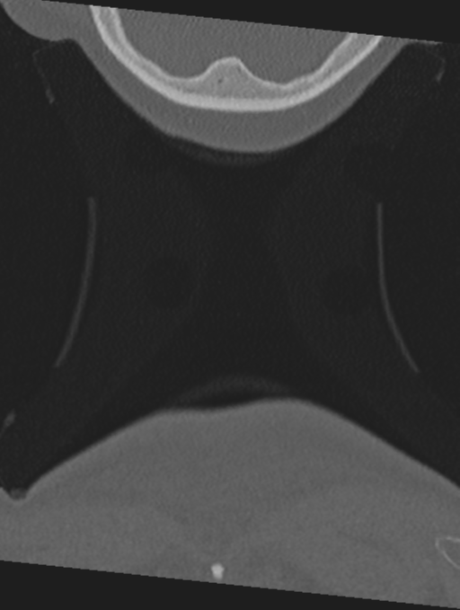 Cervical spondylolysis (Radiopaedia 49616-54811 Coronal bone window 79).png