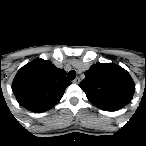 Cervical thymic cyst (Radiopaedia 88632-105335 Axial non-contrast 14).jpg