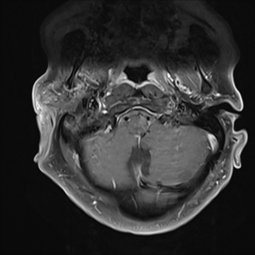 File:Cervical tumor-like myelopathy due to Type V dAVF (Radiopaedia 82461-96604 Axial T1 C+ fat sat 1).jpg