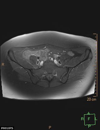 File:Cesarian scar endometriosis (Radiopaedia 68495-78066 Axial T1 C+ fat sat 3).jpg