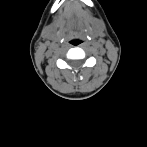 File:Chiari I malformation and obstructive hydrocephalus (Radiopaedia 41185-43981 D 49).png