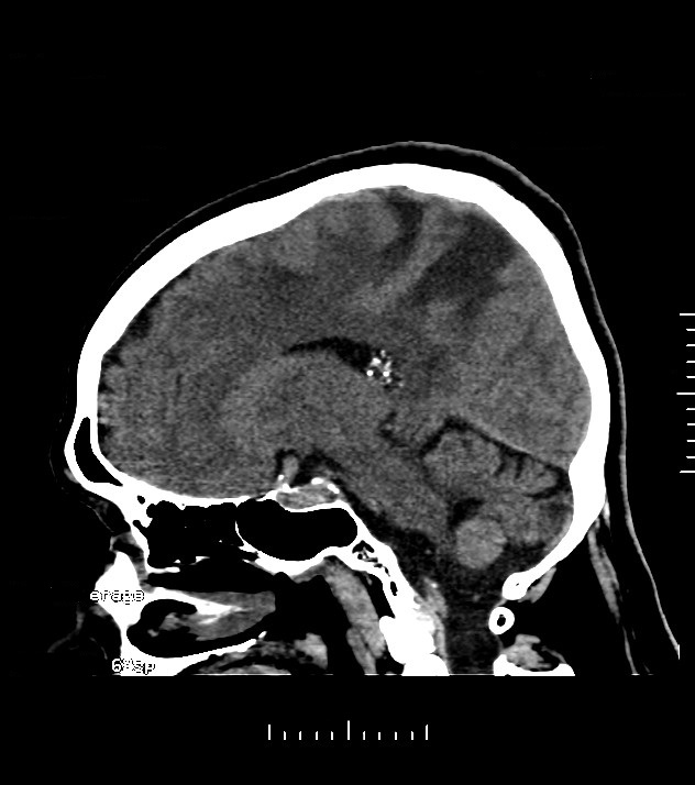 Cholangiocarcinoma with cerebral metastases (Radiopaedia 83519-98628 C 23).jpg