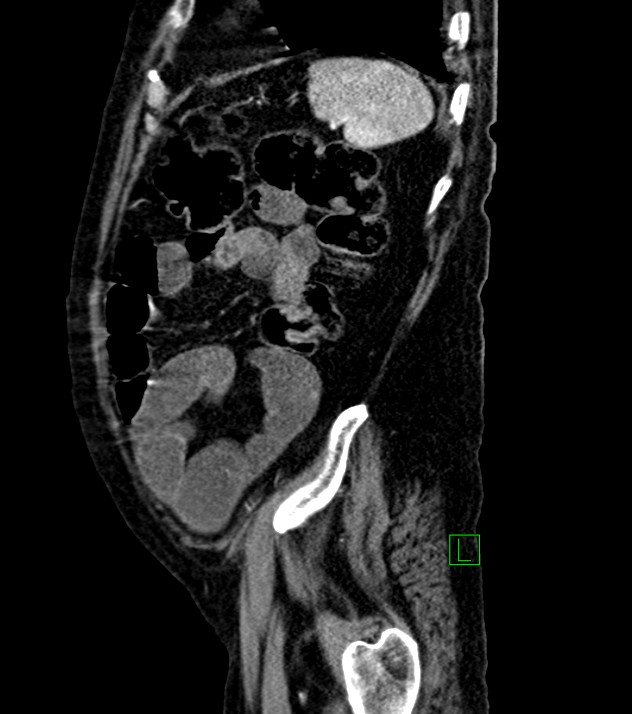 Cholangiocarcinoma with cerebral metastases (Radiopaedia 83519-98629 F 26).jpg
