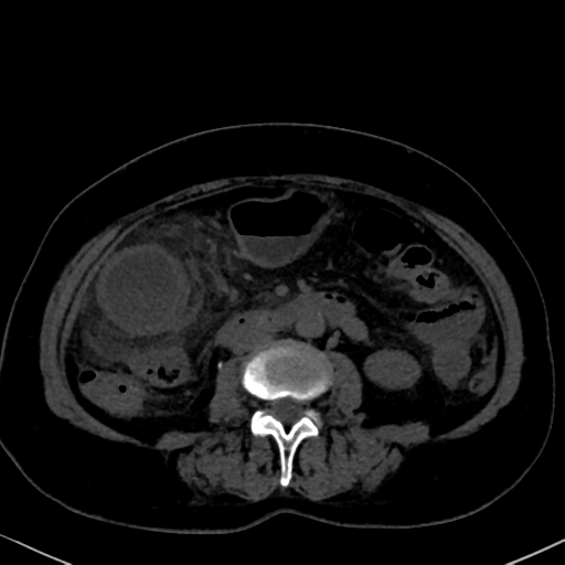 File:Cholecystitis - obstructive choledocholitiasis (CT intravenous cholangiography) (Radiopaedia 43966-47479 Axial 132).png
