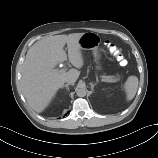 File:Cholecystitis with focal perforation and hepatic abscess (Radiopaedia 37189-38945 Axial non-contrast 21).png