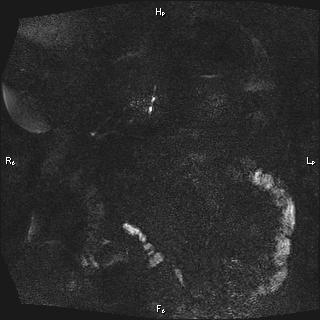 Choledochal cyst - type Ia (Radiopaedia 85673-101454 F 12).jpg