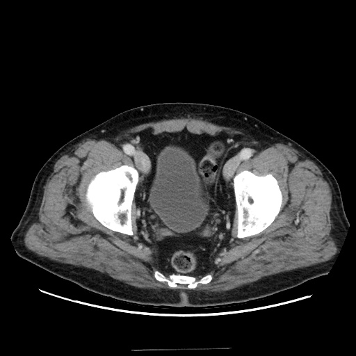 Choledocholiathiasis with normal caliber common bile duct (Radiopaedia 75368-86632 A 173).jpg