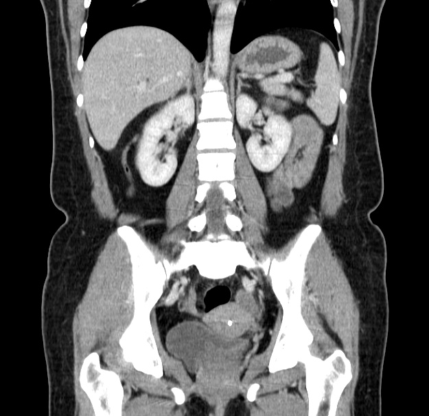 Choledocholithiasis on CT and MRI (Radiopaedia 24825-25087 C 32).jpg