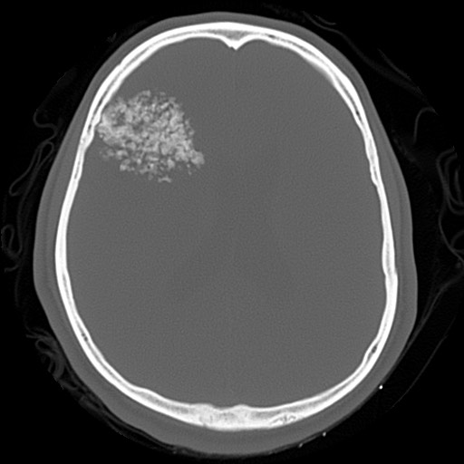 File:Chondrosarcoma - sphenoid wing (Radiopaedia 58259-67828 Axial bone window 17).jpg