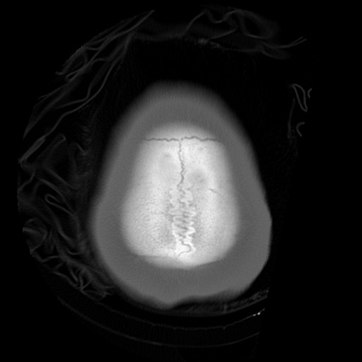 File:Chondrosarcoma - sphenoid wing (Radiopaedia 58259-67828 Axial bone window 28).jpg