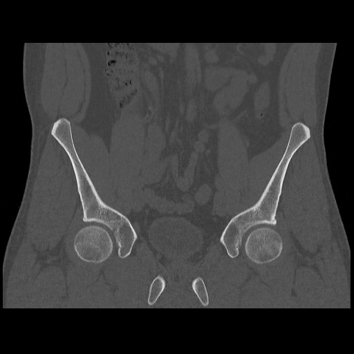 Chondrosarcoma of iliac wing (Radiopaedia 63861-72599 Coronal bone window 47).jpg