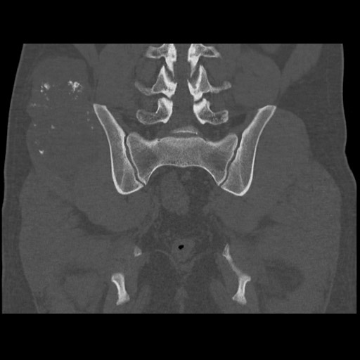 File:Chondrosarcoma of iliac wing (Radiopaedia 63861-72599 Coronal bone window 79).jpg