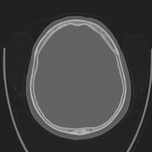 Chondrosarcoma of skull base- grade II (Radiopaedia 40948-43653 Axial bone window 33).png