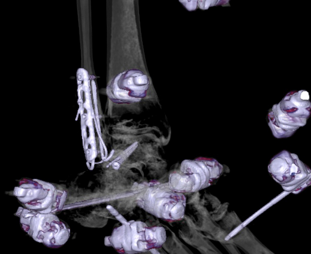 File:Chopart fracture (Radiopaedia 35347-36861 3D MPR bone window 24).jpg