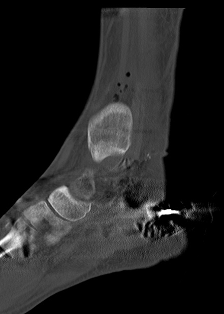 Chopart fracture (Radiopaedia 35347-36861 Sagittal bone window 33).jpg