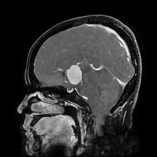 File:Chordoid glioma of third ventricle (Radiopaedia 91612-109340 F 111).jpg