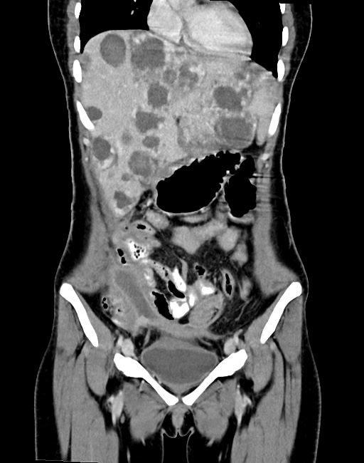 Choriocarcinoma liver metastases (Radiopaedia 74768-85766 B 37).jpg