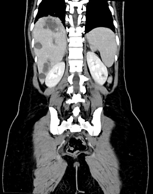 Choriocarcinoma liver metastases (Radiopaedia 74768-85766 B 76).jpg
