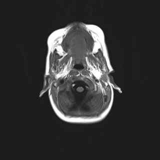 File:Choroid plexus papilloma (Radiopaedia 84612-100019 Axial T1 3).jpg
