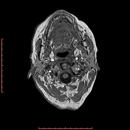 Choroid plexus xanthogranuloma (Radiopaedia 67843-77270 Axial T1 160).jpg