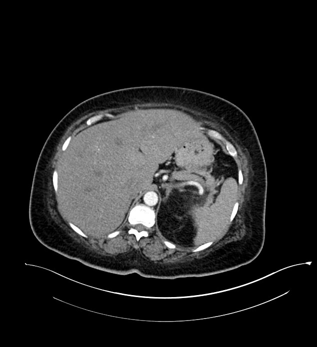 Chromophobe renal cell carcinoma (Radiopaedia 84239-99519 B 22).jpg