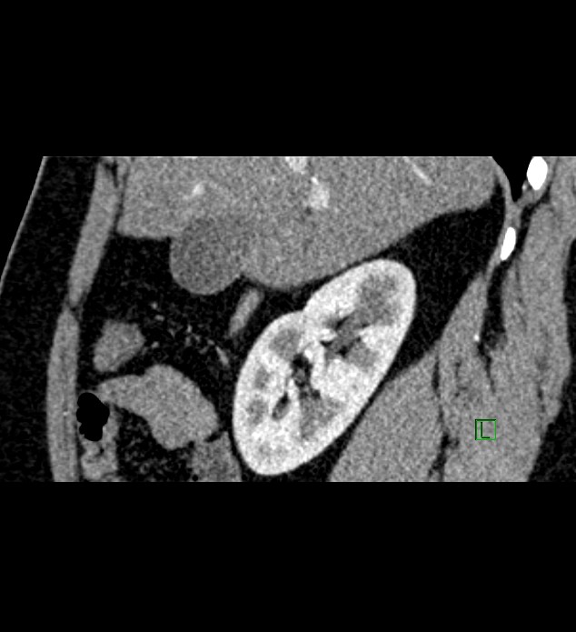 Chromophobe renal cell carcinoma (Radiopaedia 84286-99573 F 120).jpg