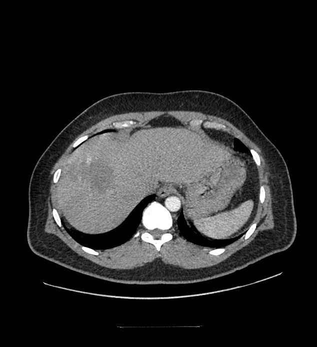 Chromophobe renal cell carcinoma (Radiopaedia 84337-99644 B 10).jpg